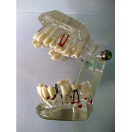 Модель челюсти (типодонт) прозрачная, с разными заболеваниями, имплантами 